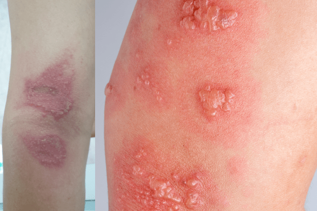 home remedies for shingles